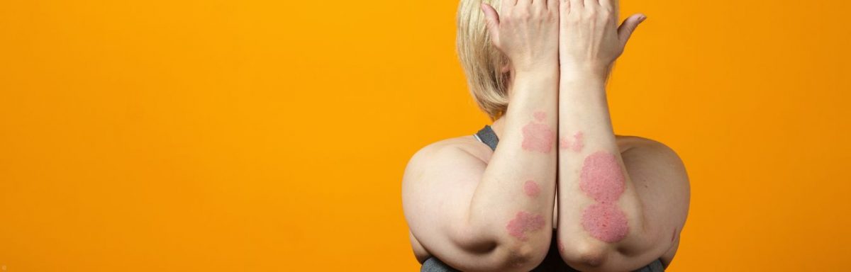 A woman standing in front of a bright yellow background. She is holding up her arms to show a large eczema rash. It's red, raised and looks itchy.